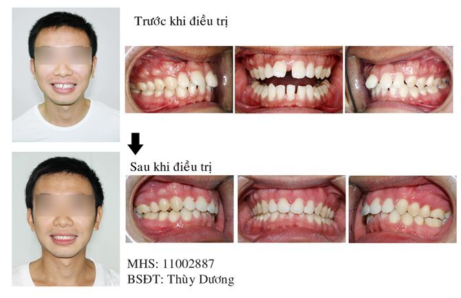 chinh nha nieng rang chinh nha nieng rang