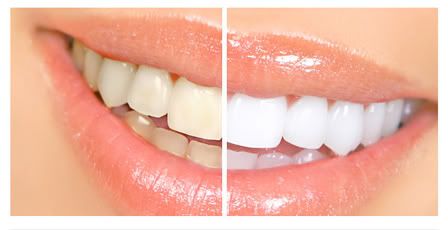 Tẩy trắng răng bằng công nghệ Deep Bleaching - Nha khoa | Răng sứ | Niềng răng | Implant | Tẩy Trắng răng