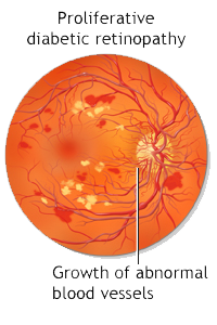 Resultado de imagen de diabetic retinopathy proliferative